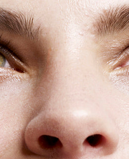 Dark Circles Under The Eyes - Causes and Treatments