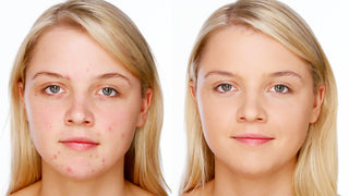 Acne/blemish Concealing Makeup using my Signature Pinpoint Technique Acne/blemish Concealing Makeup using my Signature Pinpoint Technique